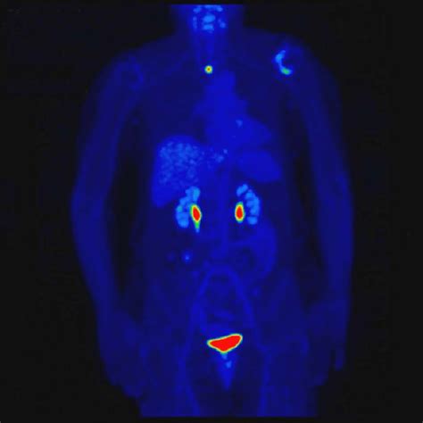 Positron Emission Tomography Computed Tomography Petct Scan Showing
