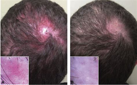 A Baseline Scalp Photograph Of The Patient With Folliculitis Decalvans