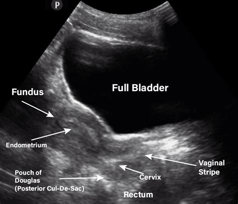 Some of the alterations in the shape of the uterus during pregnancy, such as transient asymmetry related to early gestation. Gynecology/Pelvic Ultrasound Made Easy: Step-By-Step Guide ...