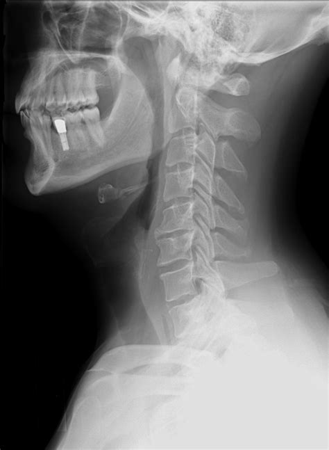 Cervicalxraylateralview Doctor Os