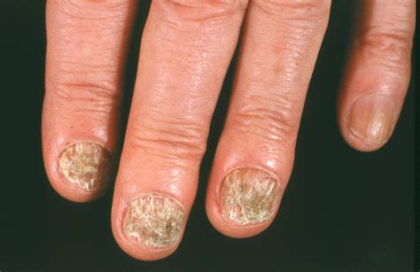 Nail Fungus Symptoms Causes And Risk Factors Home Remedy And Natural Cures