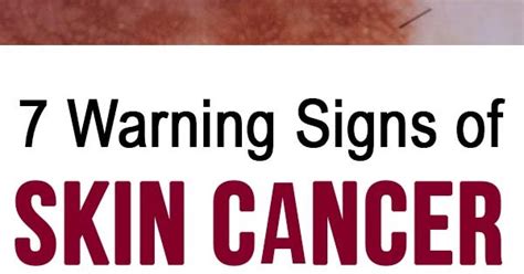 7 Skin Cancer Warning Signs You Should Never Ignore Wellness Days