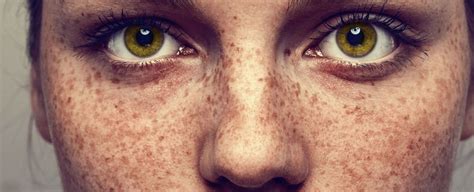 Scientists Still Dont Know Why We Get Freckles