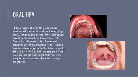 Ppt Hpv Genital Wartscancer Powerpoint Presentation Free Download