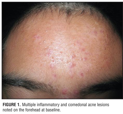 Acne Vulgaris Medical Pictures Info Health Definitions Photos