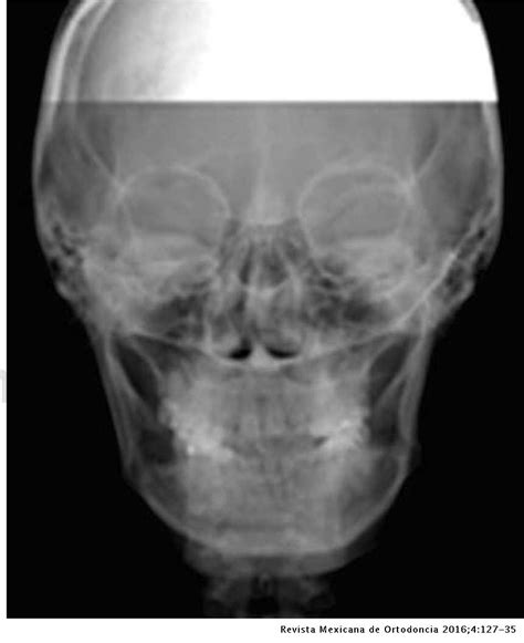Corrección De Asimetría Facial Con Tratamiento Ortodóncico Quirúrgico