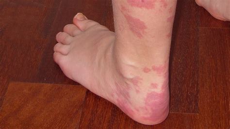 Red Spots On Legs Causes Pictures Including Small Itchy Non Itchy