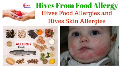 Food allergies can cause serious and even deadly reactions. Hives From Food Allergy - Hives Food Allergies and Hives ...