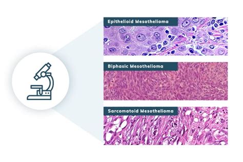 Mesothelioma Pathology Why It Matters For Diagnosis