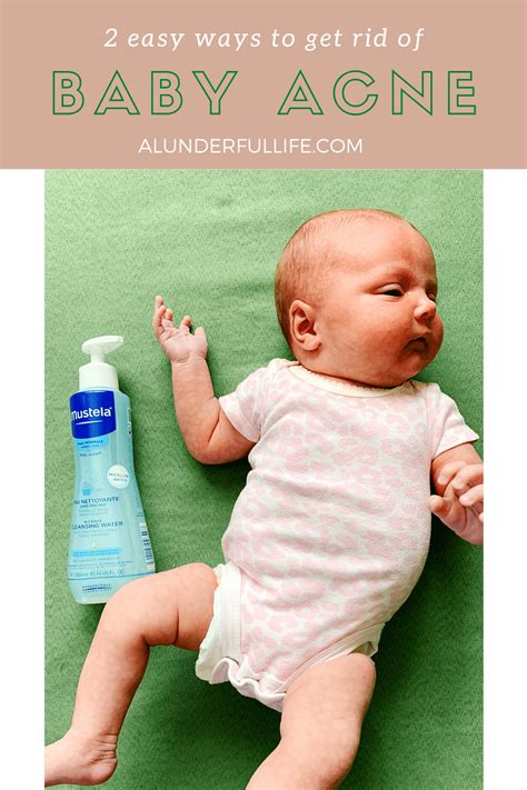 Hot To Get Rid Of Baby Acne In Three Days A Lunderful Life Baby