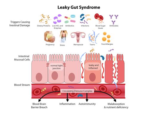 10 Home Remedies For Leaky Gut Syndrome And Your Overall Digestion Health