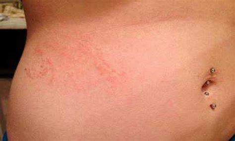 Scabies Rash Look Like Causes