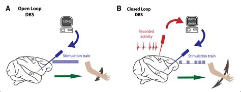 Stimulation On Demand Closing The Loop On Deep Brain Stimulation Neuron