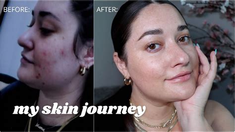 My Skin Journey Youtube