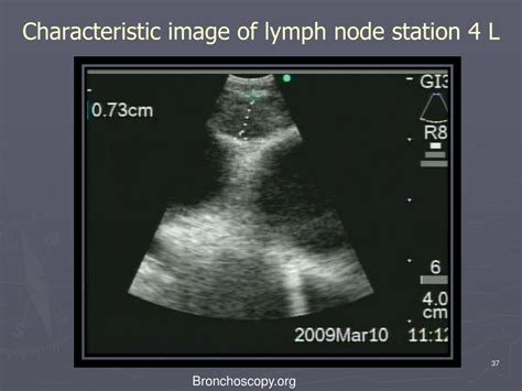 Ppt 8 Planning Ebus Tbna Of Left Lower Paratracheal Lymph Node