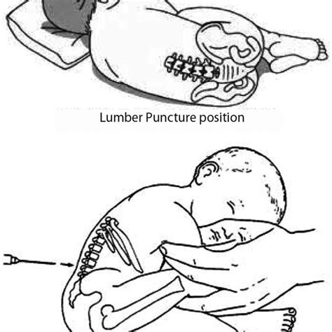 Lumbar Puncture Positions For A Child Download Scientific Diagram