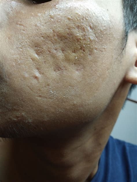 Help Me With These Acne Scars Scar Treatments