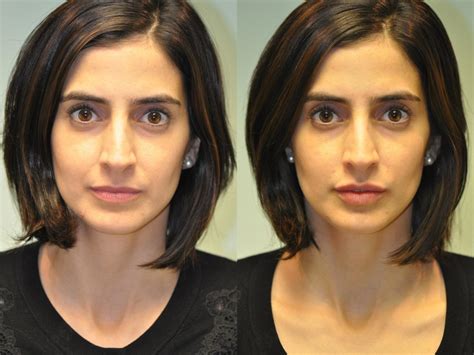 lip augmentation photos chevy chase md patient 11888