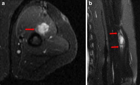 Mri Characteristics Of Nodular Fasciitis Of The Musculoskeletal System