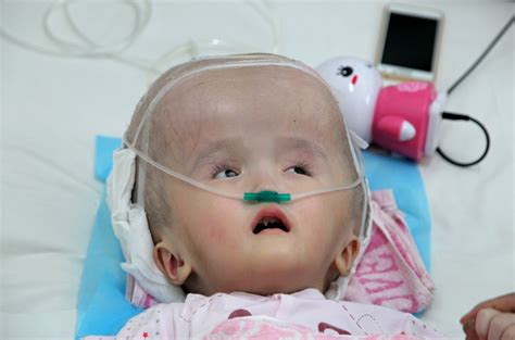 China Big Head Toddler Receives Life Saving 3d Printed Titanium