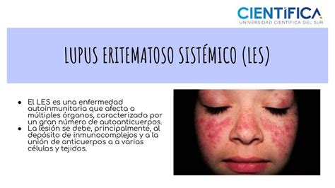 Lupus Eritematoso Sitemico Les Apuntes Médicos Udocz