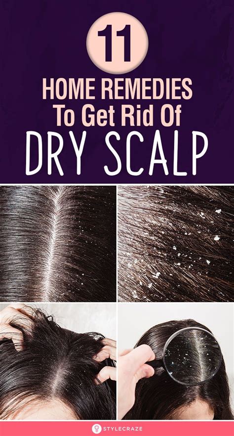 10 Best Home Remedies To Get Rid Of Dry Scalp Dry Scalp Dry Scalp