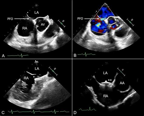 Advances In The Management Of Cardioembolic Stroke Associated With