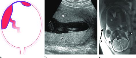 Succenturiate Lobe Placenta Ultrasound