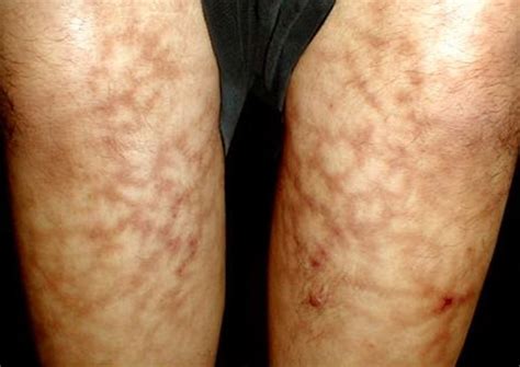 Symptomatic Livedo Reticularis Livedo Racemosa Causes Symptoms And