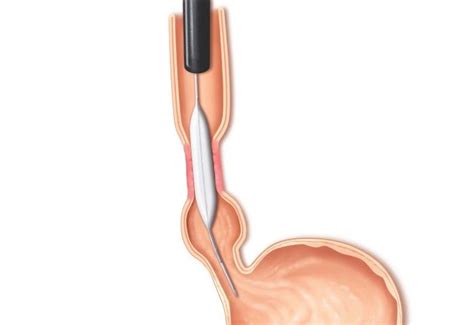 Olympus Stricture Management Balloon Dilation Medical Systems