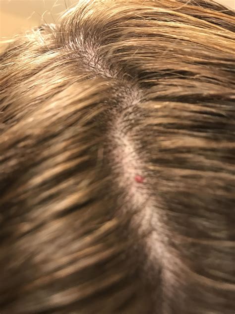 Anyone Know What His Red Thing Is On My Scalp I Have A Ton Of Them On