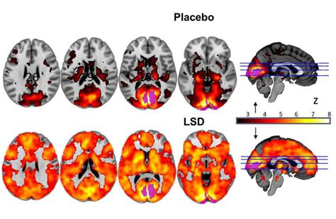 New Study Reveals What A Brain On Lsd Actually Looks Like And This Is