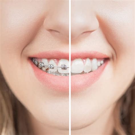 9 Ways Braces Improve Your Oral Health Smile Craft Dental Studio