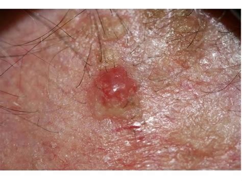 Most caused by merkel cell polyomavirus. Dermpath Made Simple - Neoplastic: Merkel Cell Carcinoma