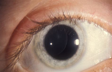 Dislocated Lens In Marfans Syndrome © Clare Gilbert Int Flickr