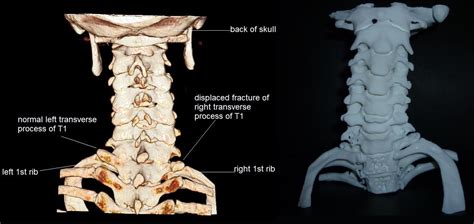 Damaged Spine Only Evident 20 Years After Injury Thanks To 3d Printing