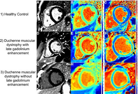 Example Cardiac Mri Images 1 Healthy Control Without Late Gadolinium