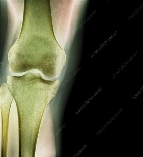 Normal Knee X Ray Stock Image F0033639 Science Photo Library