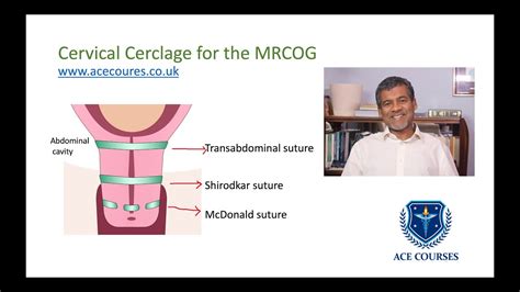 Cervical Cerclage For The Mrcog Rcog Guideline Preterm Birth
