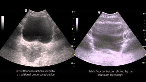 Comparison By Ultrasound Of Pelvic Floor Muscle Stimulation Youtube