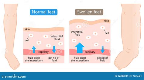 Swollen And Normal Feet With Skin Diagram Swelling Is Caused By Excess