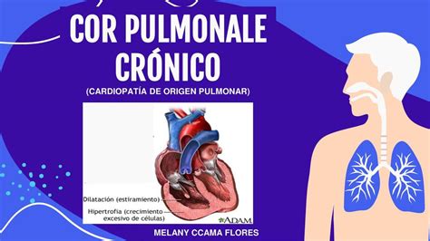 Cor Pulmonale Crónico Melanyccama Udocz