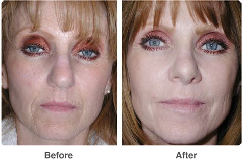 Chemical Peel Results Beauty By Design Las Vegas And Corona Del Mar