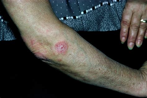 Psoriasis Affecting Womans Upper Arm Photograph By James Stevenson