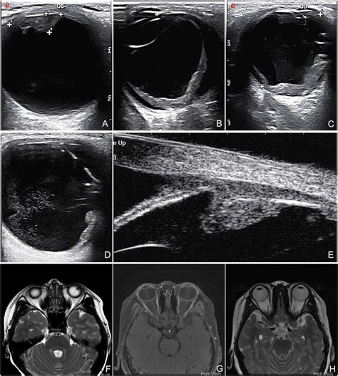 Imaging Examination Of Diffuse Infiltrating Retinoblastoma