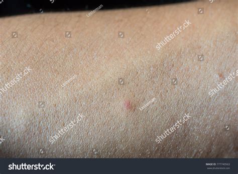 Closeup Skin Allergy Insect Bite Mosquito Stock Photo 777740563