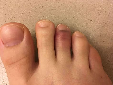 Broken Toe 10 Broken Toe Symptoms
