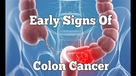 Colon Cancer Symptoms That You Shouldn T Ignore YouTube