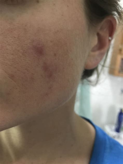 Pimples Clustered On One Cheek Adult Acne