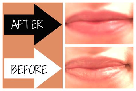 How Can I Fix Chapped Lips Fast